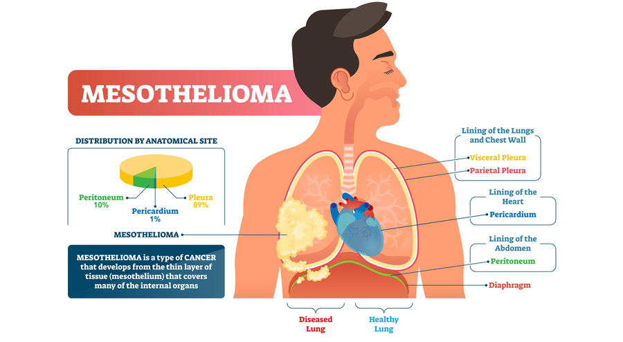 What Is Mesothelioma